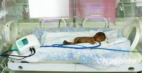 重慶最袖珍嬰兒僅重610克 腦袋僅有鵝蛋大