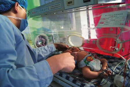 雙頭女嬰存活150天19小時離世 已是生命奇跡