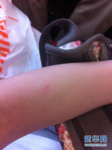 索尼RX100驚現(xiàn)“夾肉事件” 玩相機(jī)也流血？