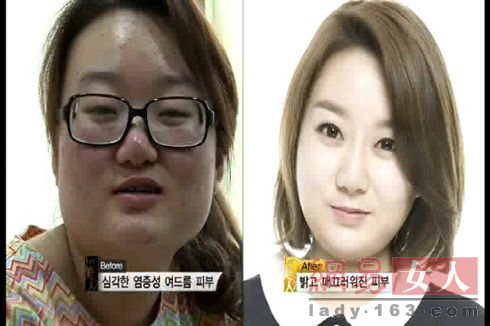 丑女變靚妹！韓國(guó)整容節(jié)目爆紅