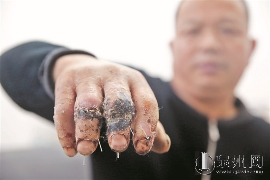 患者投訴醫(yī)院中指無名指錯(cuò)接 醫(yī)院:要等鑒定結(jié)果