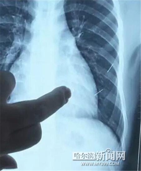 雙鴨山一少年體內扎進四根針 一根扎進心臟4厘米(圖)