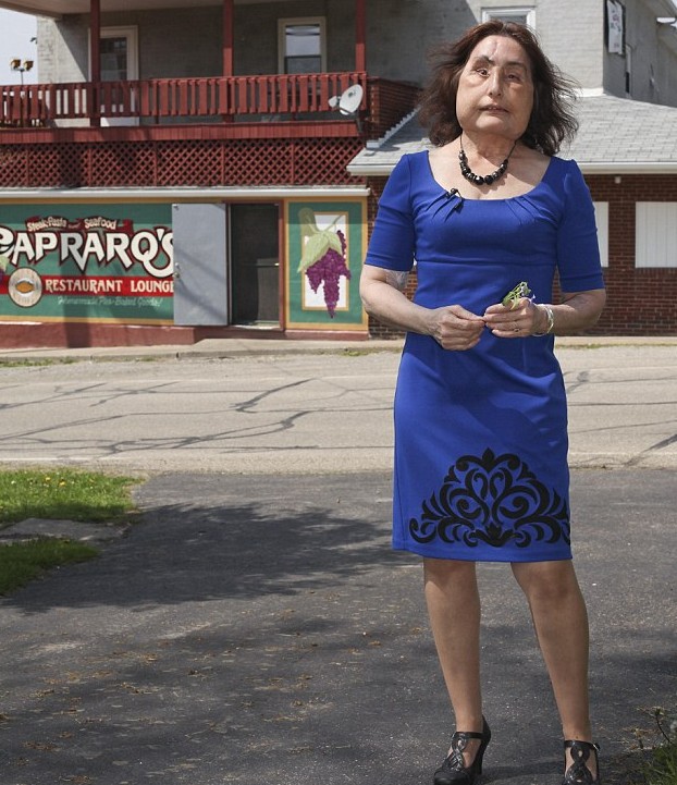 美國“換臉女”的人生奮斗 雖與兇手丈夫離婚但愛心不變