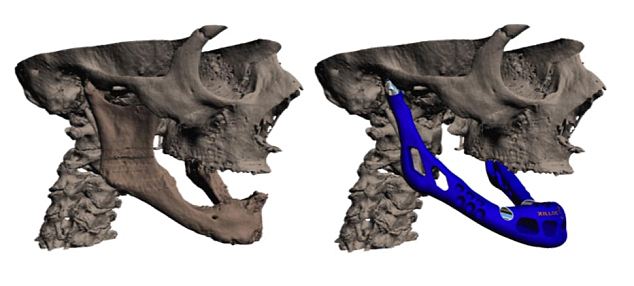 骨科治療新突破：世界首例3D打印下頜移植手術細節公布