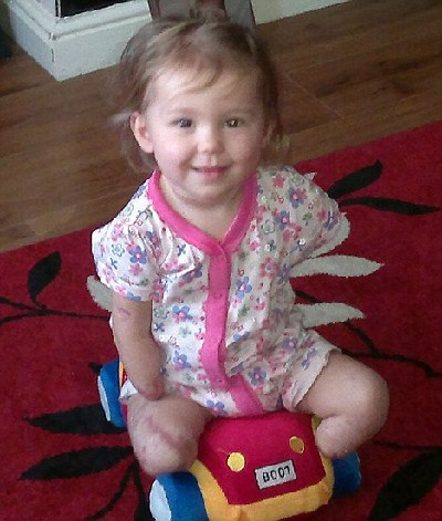 英國(guó)2歲女孩因腦膜炎被截四肢 頑強(qiáng)樂(lè)觀面對(duì)生活