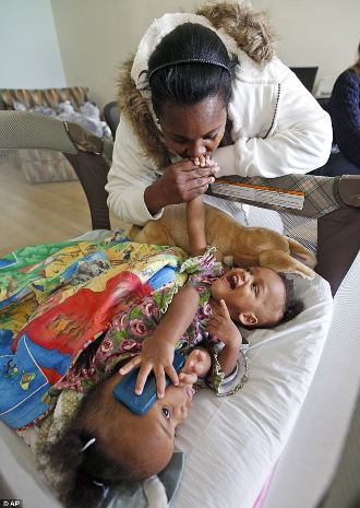 連體女嬰在美成功分離 曾共用肝臟等器官(組圖)