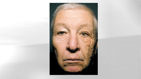 常年日曬讓美國老漢“變臉” 左右相差20歲