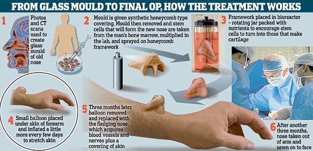 手臂上長(zhǎng)出鼻子！人體器官再生技術(shù)獲突破