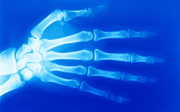 研究發現結核病菌能潛伏于患者骨髓中