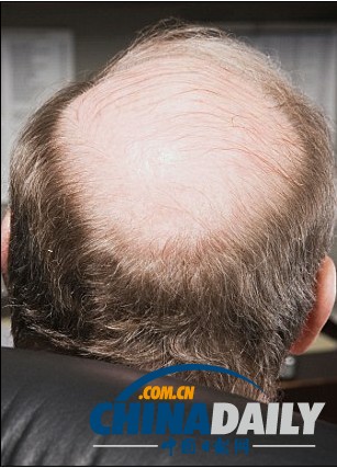 白發(fā)變黑將成真 “吸血鬼療法”有效治禿頂