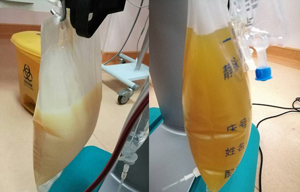 中山男子腹痛緊急送醫搶救，檢出“牛奶血”！