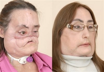 US 1st face transplant patient shows face